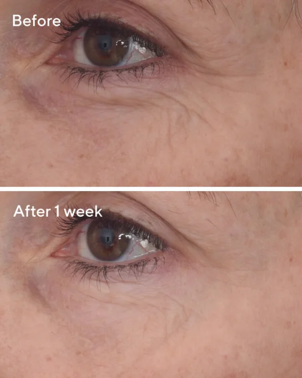 Retinal ReSculpt Eye Lift Treatment